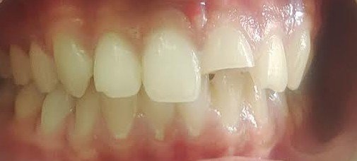10. Cosmetic Smile Designing & Porcelain Veneers - Before