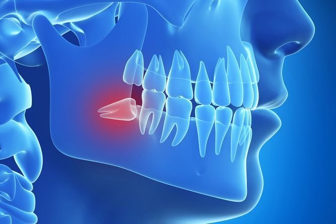 14. Painless Wisdom Tooth Removal