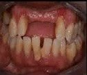 18. Full Mouth Rehabilitation & Bite Reconstruction - Before