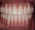 18. Full Mouth Rehabilitation & Bite Reconstruction - After