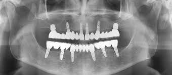 18. Full Mouth Rehabilitation & Bite Reconstruction - After