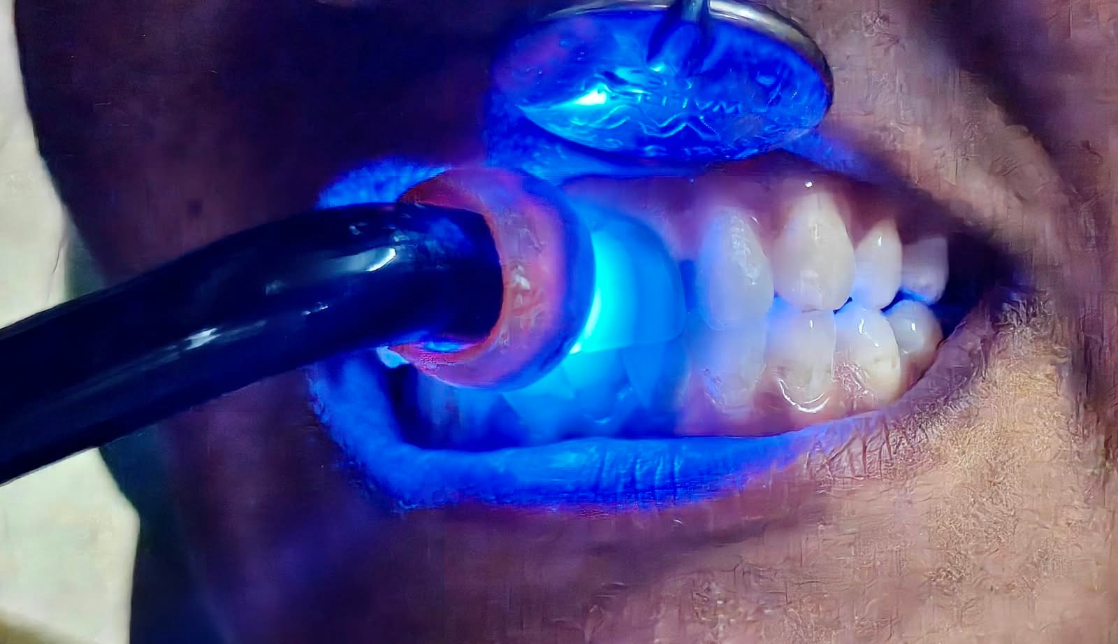 5. Tooth-Colored Restorations (Bonding)