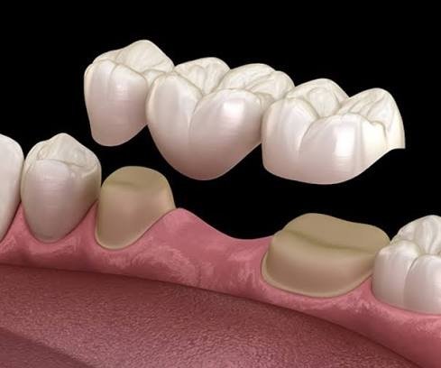 7. Precision CAD/CAM Crowns & Bridges